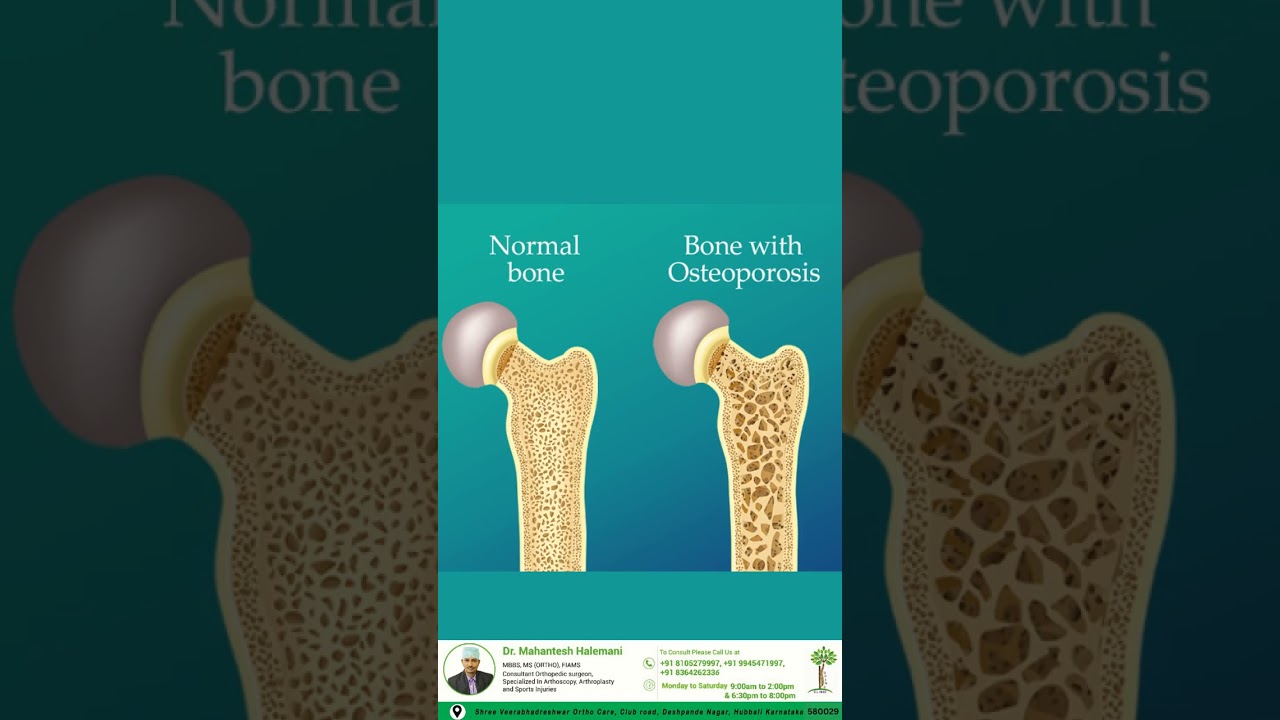 Osteoporosis | Bone Health Tips
